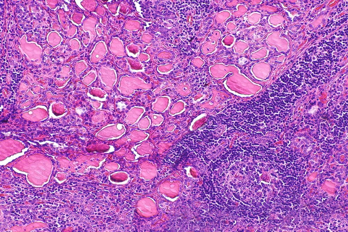 Срез щитовидной железы. Аутоиммунный тиреоидит зоб Хашимото микропрепарат. Зоб Хашимото гистология. Аутоиммунный тиреоидит щитовидной железы гистология.