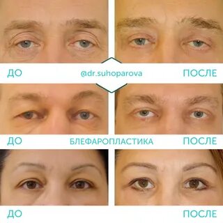 Блефаропластика век фото до и после отзывы