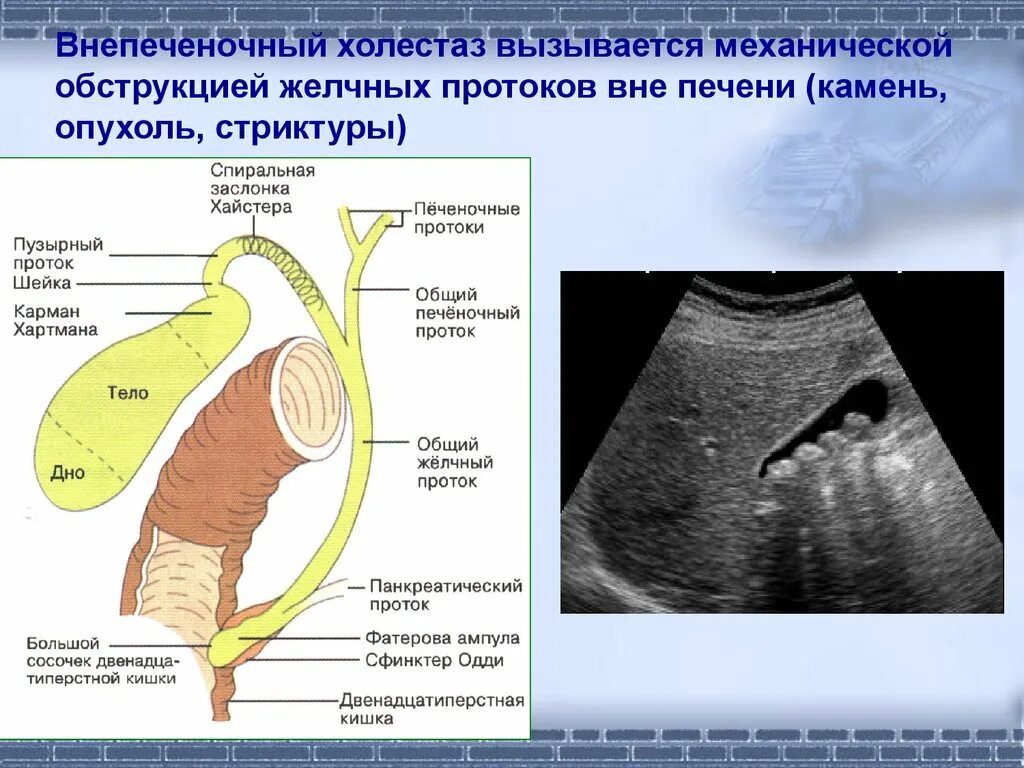 Обструкция желчных протоков. Обструктивный внепеченочный холестаз. Обтурация желчевыводящих протоков.