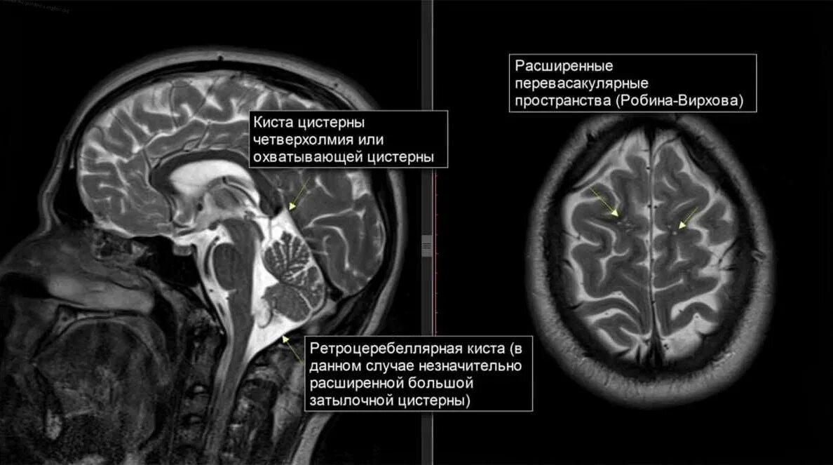 Расширение ликворосодержащих пространств