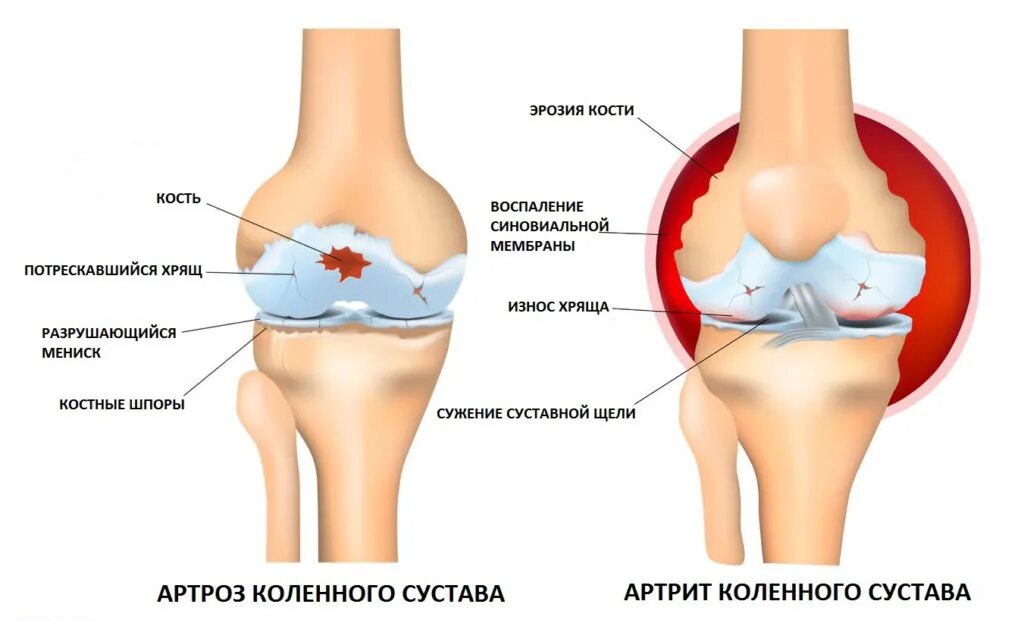 Артрит и артроз разница