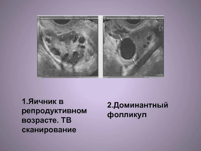 Фолликул 18 мм. Узи яичников доминантный фолликул. доминантный фолликул на узи. доминантный фолликул в яичнике. фолликул доминантный фолликул.
