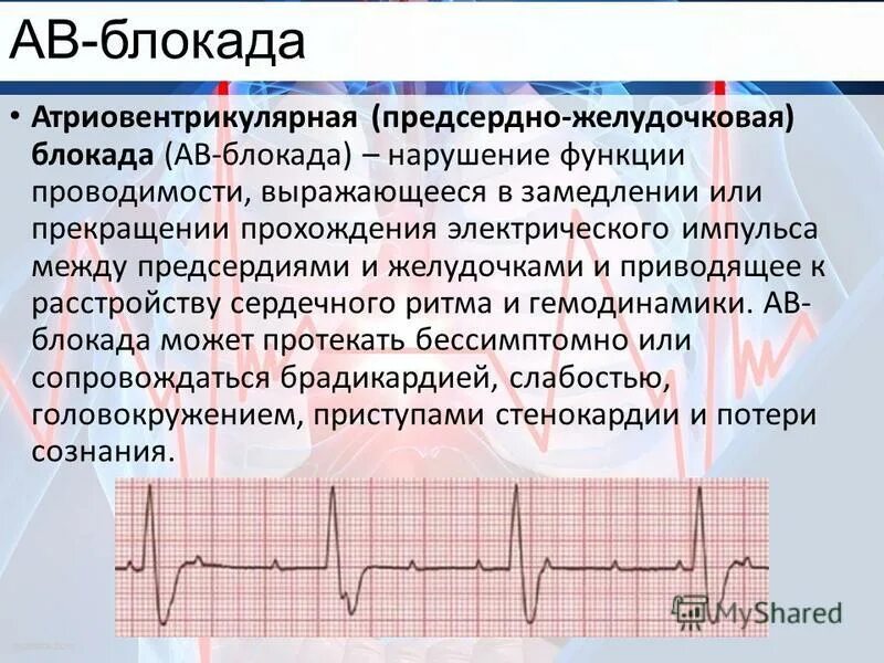 Как действует блокада. Полная АВ блокада. Атриовентрикулярная блокада. Врожденная полная АВ блокада. Антривентилярная блокада.