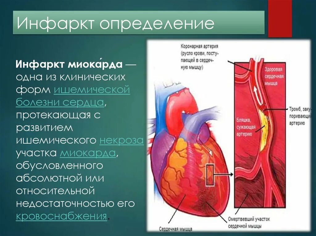 Варианты острого инфаркта миокарда