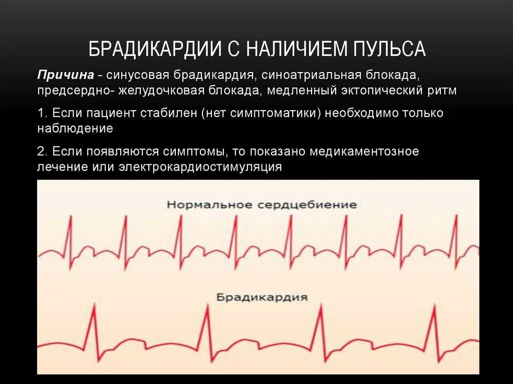 Ощущается пульс. Частый и редкий пульс. Заболевания связанные с пульсом. Редкое сердцебиение. ЭКГ при нарушениях ритма сердца.