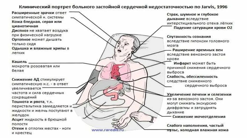 Увеличение печени при ХСН. Увеличенная печень при ХСН. Вынужденное положение при сердечной недостаточности. Застойной сердечной недостаточности. Нагрузки при сердечной недостаточности