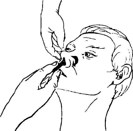 Проведение туалета тяжелобольного пациента. Острый ринит передняя риноскопия. Удаления корочек из носовых ходов используется. Удаления корочек из носовых ходов используется. Удаления корочек из носовых ходов используется.