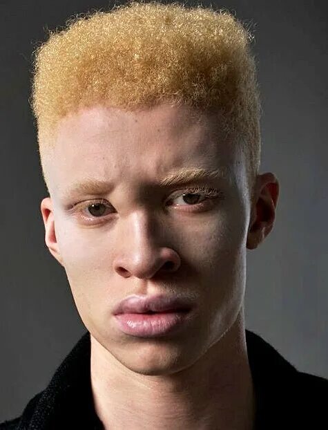 Афроамериканец альбинос. Рыжий альбинос. Рыжий мальчик. Рыжий альбинос. Шон росс фото.