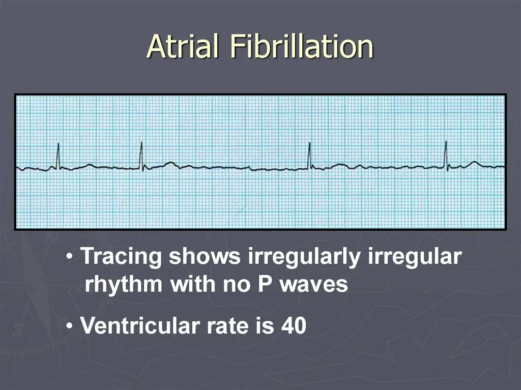 Работает fib звук. Atrial fibrillation. atrial fibrillation causes. signs of atrial fibrillation. atrial fibrillation type.
