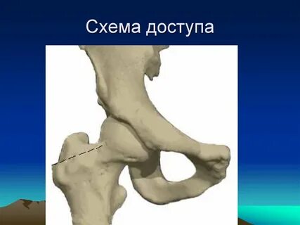 Вывих бедра