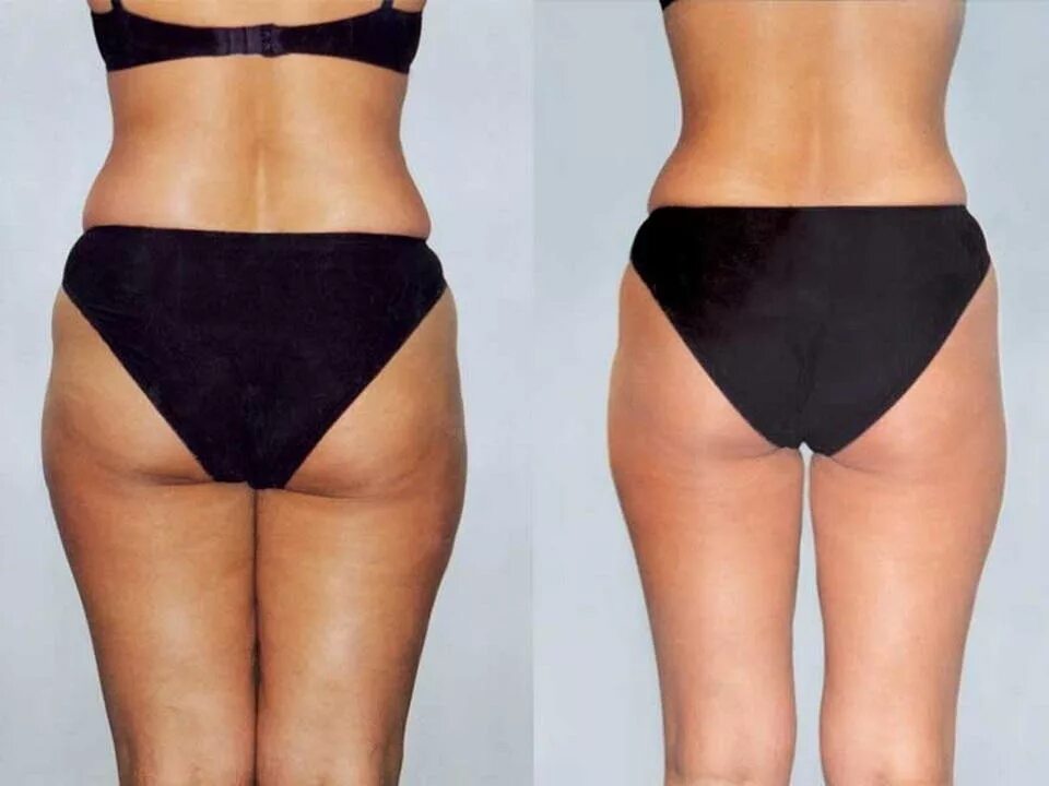 Массаж для похудения отзывы. Массаж для похудения отзывы. Массаж для похудения отзывы. Вакуумный массаж живота до и после. Целлюлит до и после массажа.