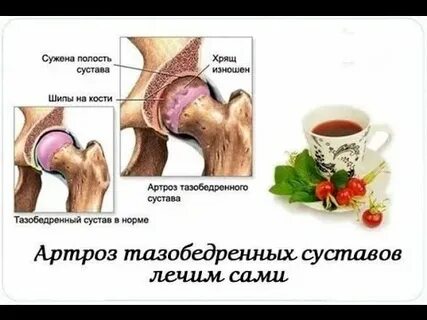 Можно ли вылечить тазобедренный артроз