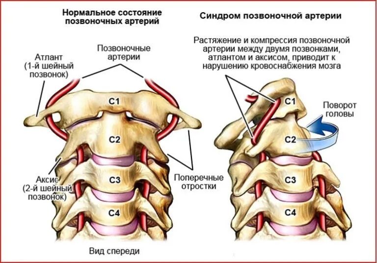 Синдром экстравазальной компрессии позвоночной артерии. Анатомия позвоночной артерии в шейном отделе. Синдром позвоночной артерии остеохондроз шеи. Синдром позвоночной артерии при шейном остеохондрозе симптомы.