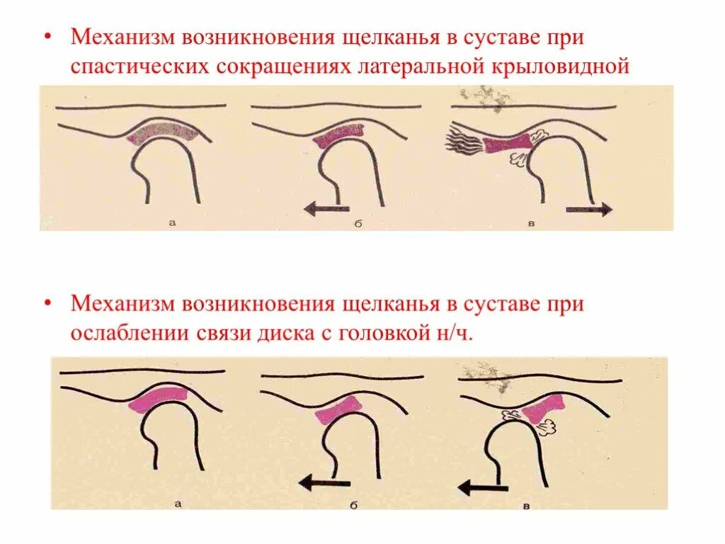 Причина щелканья. Причины и механизмы щелканья в суставах. механизм щелчков сустава внчс. каковы причины и механизм щелканья в суставах. механизм возникновения.