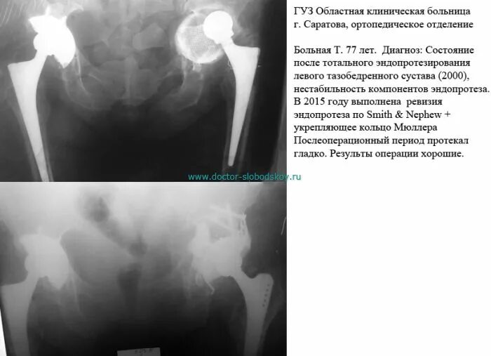 Мрт после эндопротезирования. Эндопротез тазобедренного сустава рентген протокол. Ревизия тазобедренного эндопротеза. Тотальное эндопротезирование тазобедренного сустава кт. Рентген эндопротеза тазобедренного.