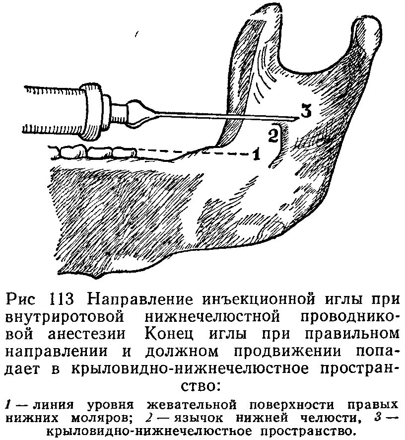 Анестезия по гейтсу. Мандибулярная анестезия нижней челюсти. Проводниковая анестезия нижней челюсти торусальная. Внутриротовая проводниковая анестезия. Проводниковая анестезия мандибулярная техника.