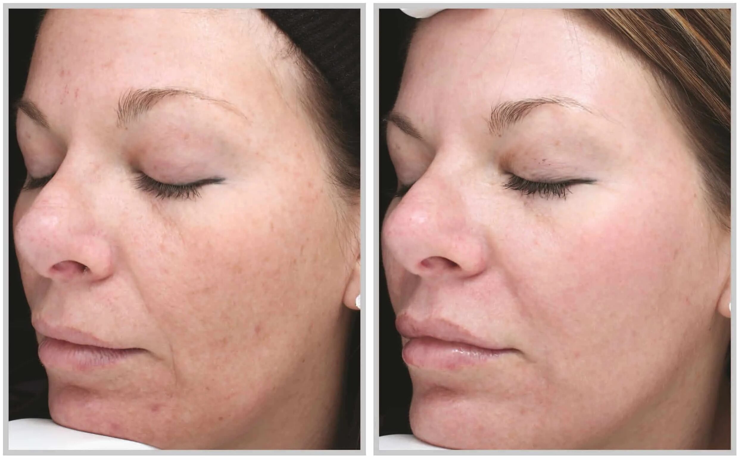 Axis y pha resurfacing glow peel