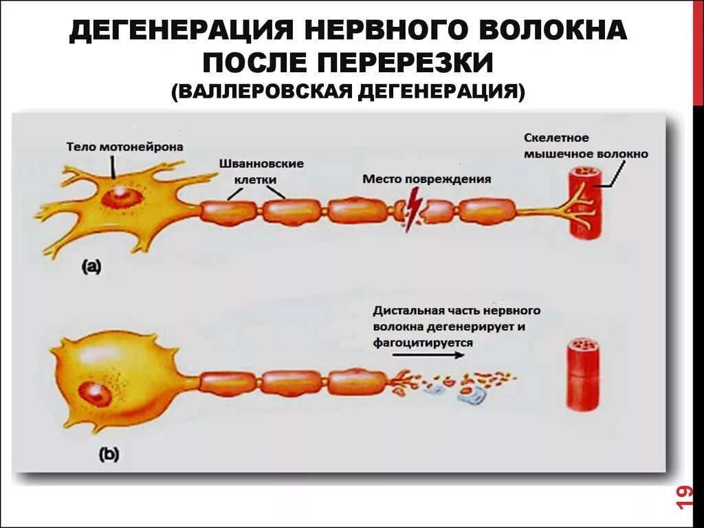 Дегенерация и регенерация нервных волокон. Валлеровское Перерождение нервных волокон. Валлеровское Перерождение нейрона это. Дегенерация периферического нерва.