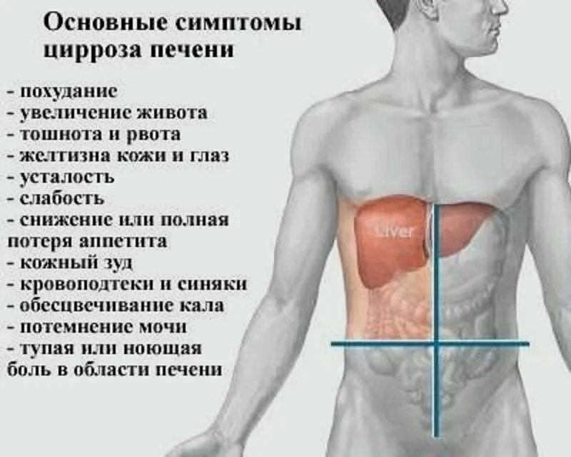 Печень не справляется. Симптомы цейрозы печени. Симптомы церозапечент. Если болит печень симптомы.