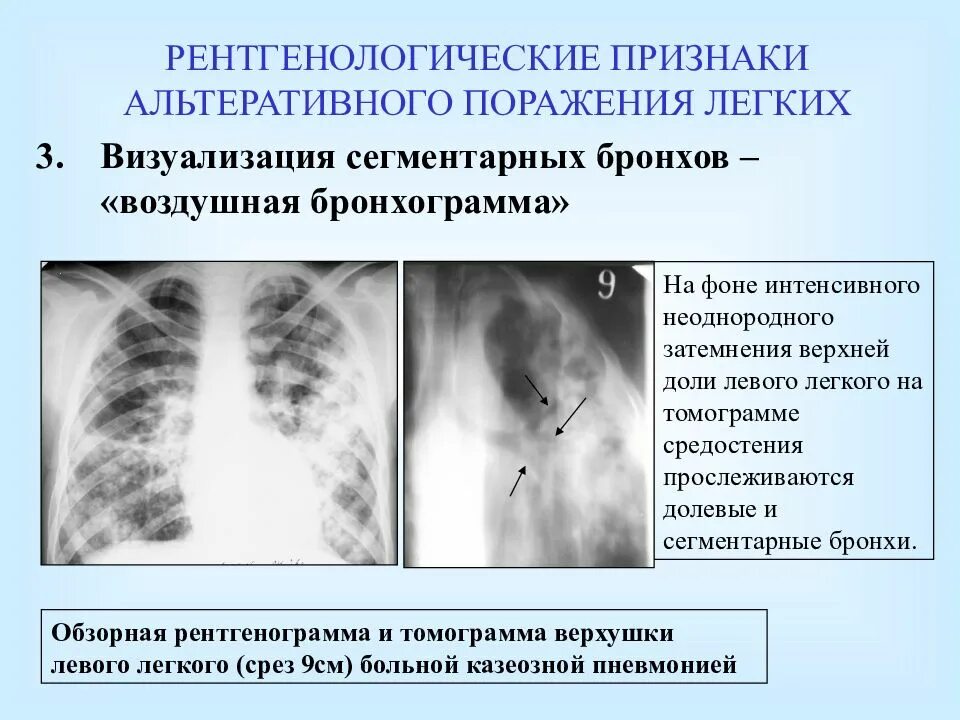 Что значит сегментарная пневмония