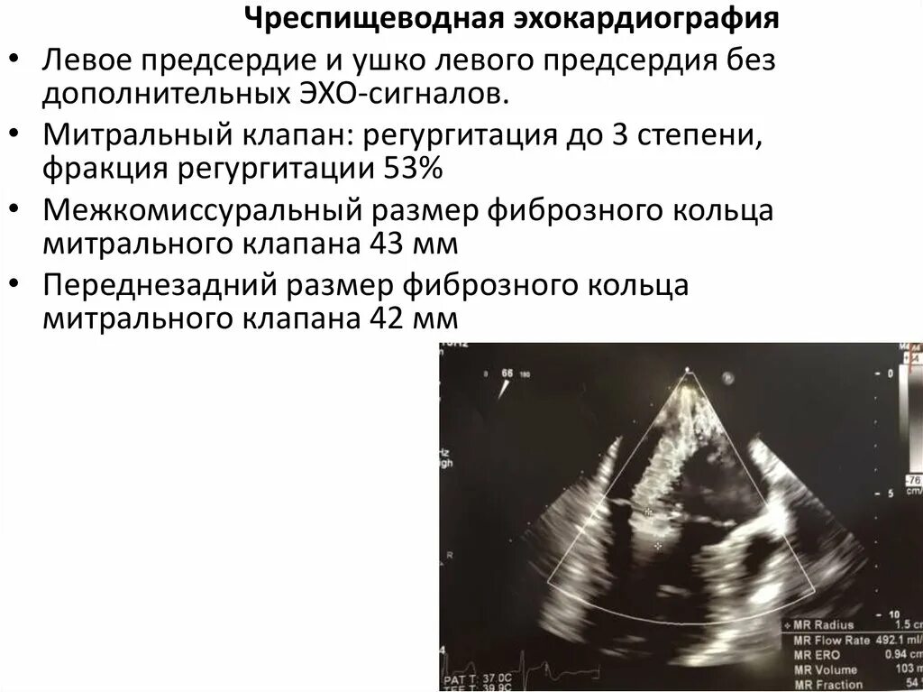 Регургитация митрального клапана на ЭХОКГ. Степени митральной регургитации по ЭХОКГ. ЭХОКГ митральная регургитация 1 степени. Степени регургитации митрального клапана по УЗИ. Регургитацией называется