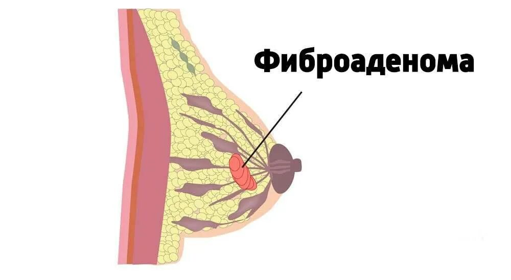 Фиброма в груди. Фиброаденома молочной железы. Фиброаденома в молочной железе.