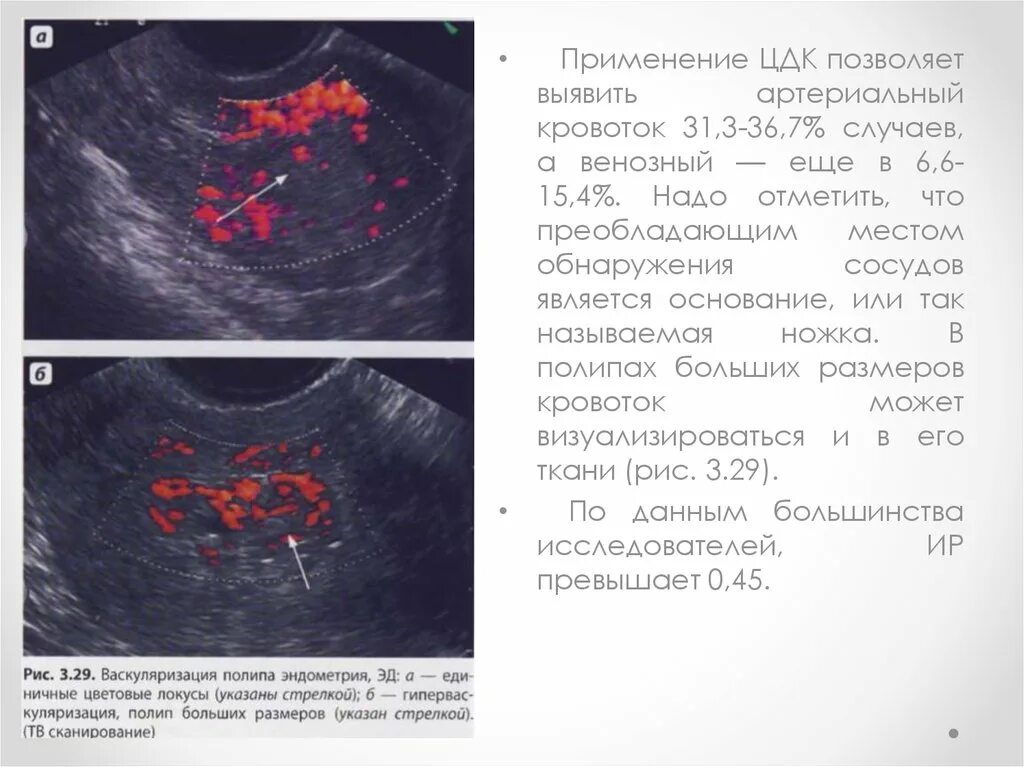 Изменение эндометрия матки. Цветовое допплеровское картирование при полипах эндометрия. Полипоз эндометрия на УЗИ. Кровоток в полип эндометрия УЗИ.