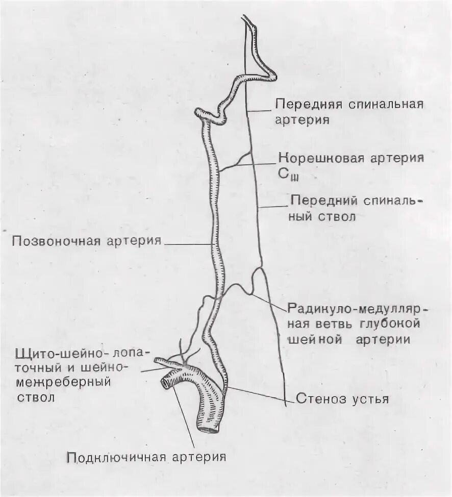 2 сегмент позвоночной артерии. Септальный стеноз подключичной артерии. стеноз подключичной устье артерии. стеноз устья позвоночной артерии. сегменты позвоночной артерии схема кт.