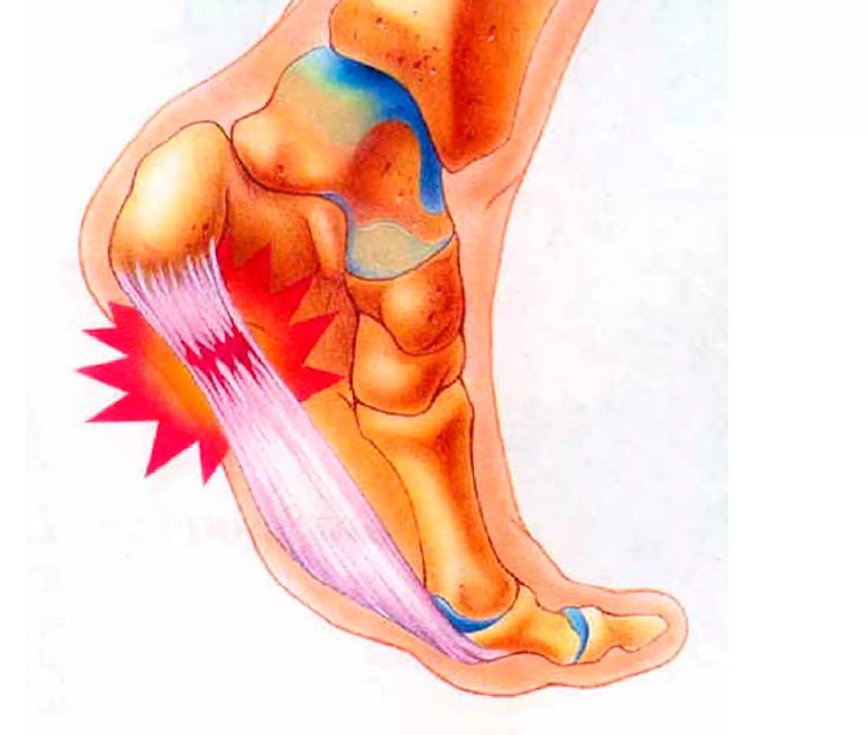Плантарный фасциит стопы. Некротический фасциит стопы. Воспаление плантарный фасциит. Плантарный фасциит шпора. Бег болит пятка