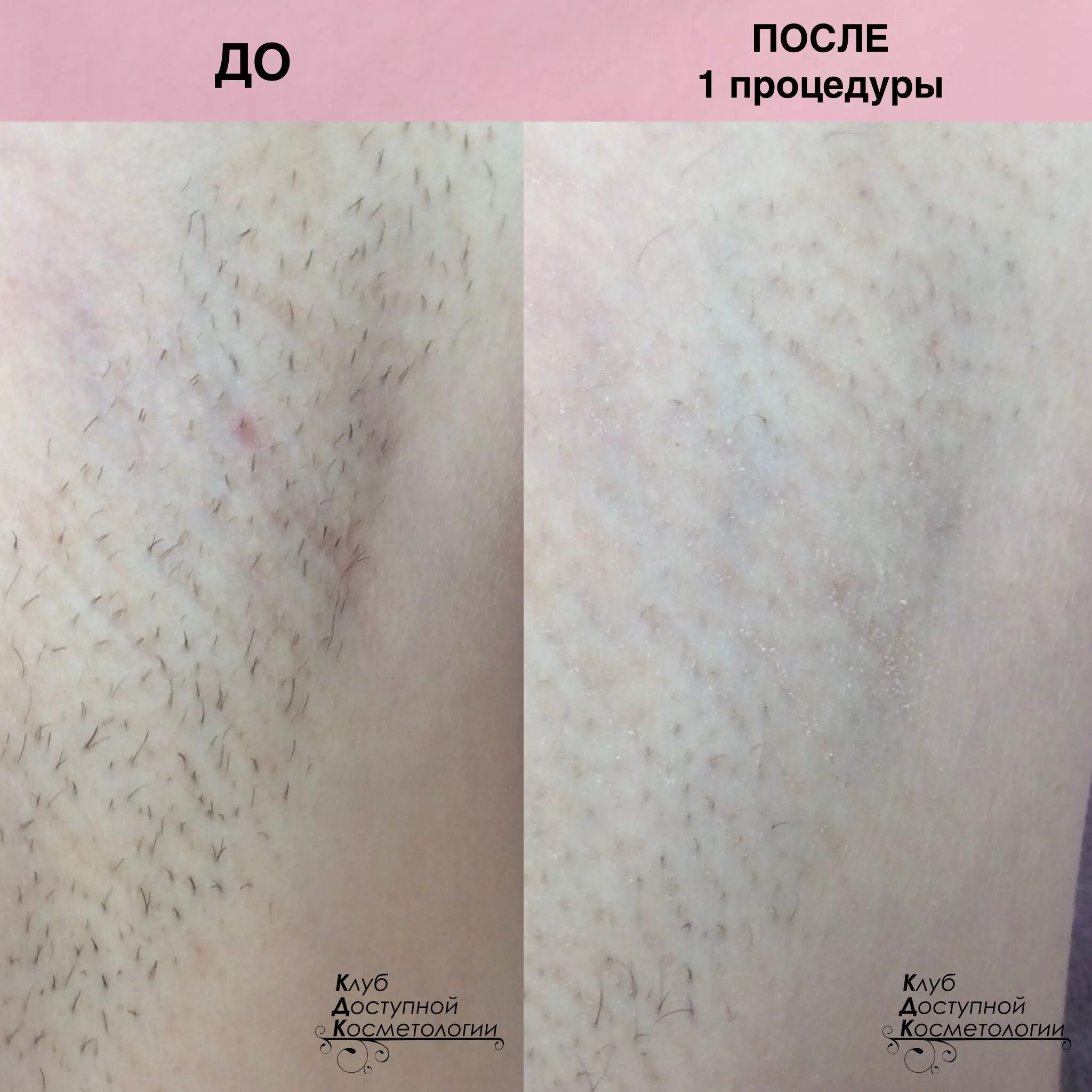 Через сколько загорать после лазерной эпиляции. Лазерная эпиляция элос. лазерная эпиляция результат. процедура лазерной эпиляции.