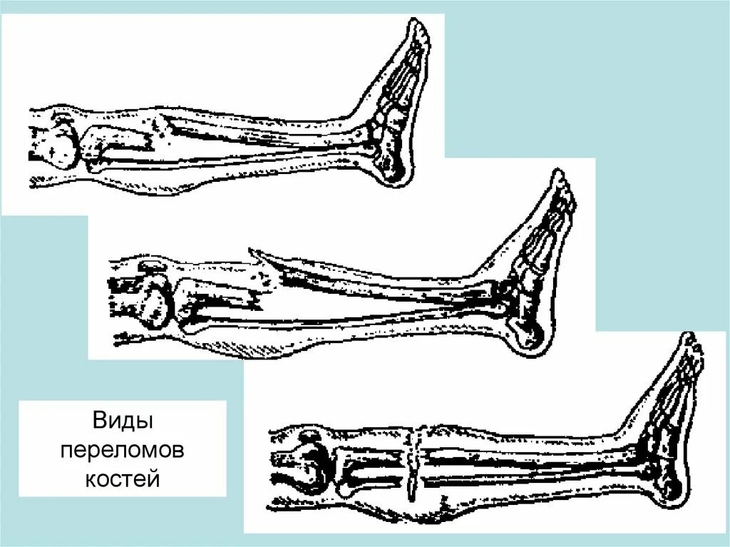 Эпифизарные переломы кости. Продольный и поперечный перелом кости. Формы переломов костей.