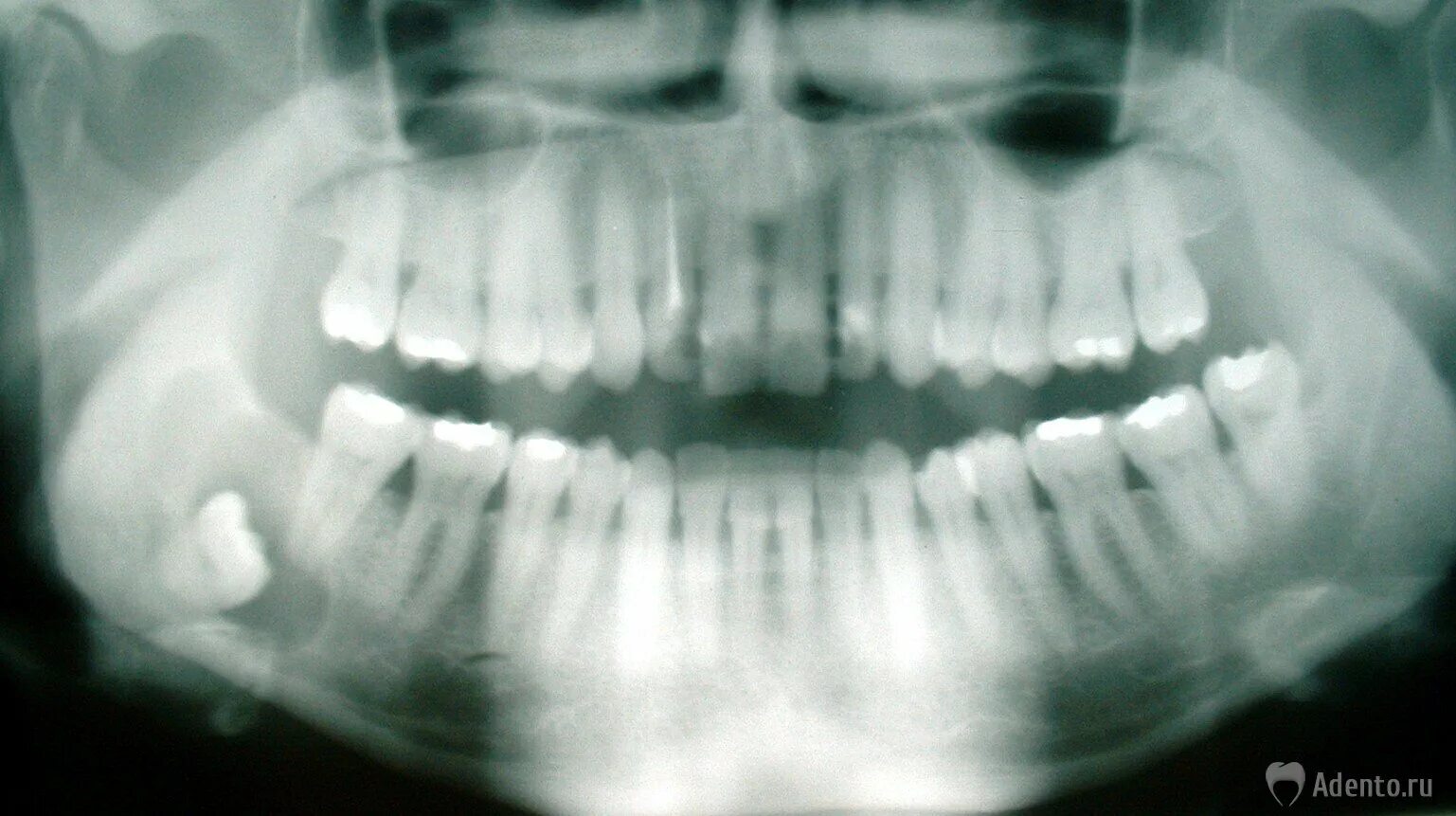 Зубы девятки. Девятый зуб у человека. Фолликулярная киста челюсти рентген. Восьмерки зубов на снимке. Фолликулярная киста челюсти.
