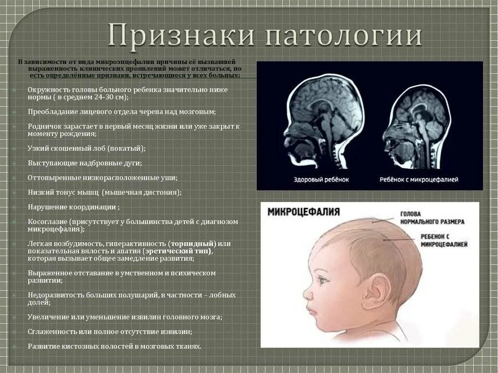 Поражение мозга у новорожденных. Морфофункциональная незрелость головного мозга новорожденного это. Микроцифалияголовного мозга. Микроцефалия головного мозга у ребенка. Череп микроцефальной формы.