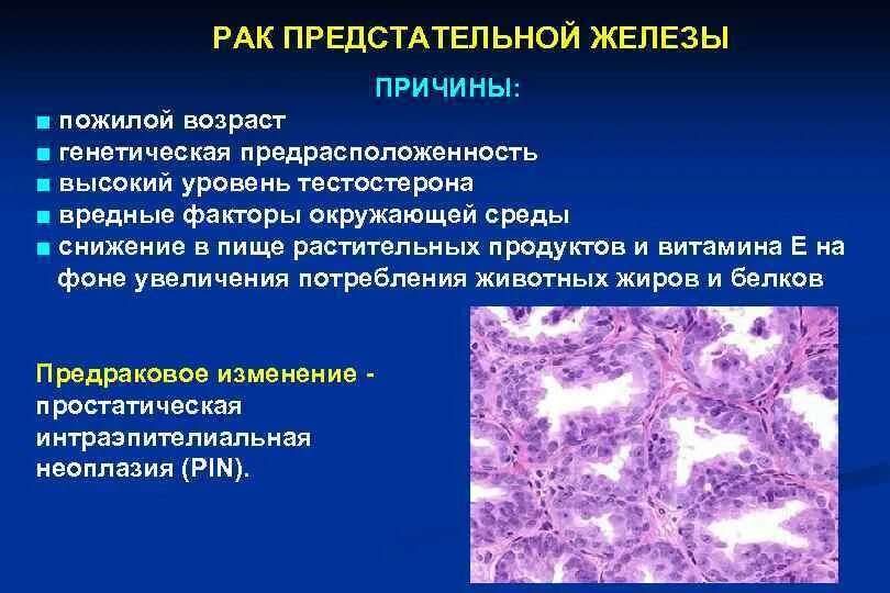 ОПК предстательной железы. Заболевания половых органов. Злокачественное новообразование предстательной железы. Опухоли предстательной железы факторы.