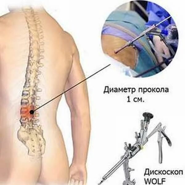 Позвоночная грыжа операция. Стабилизирующие операции на позвоночнике.