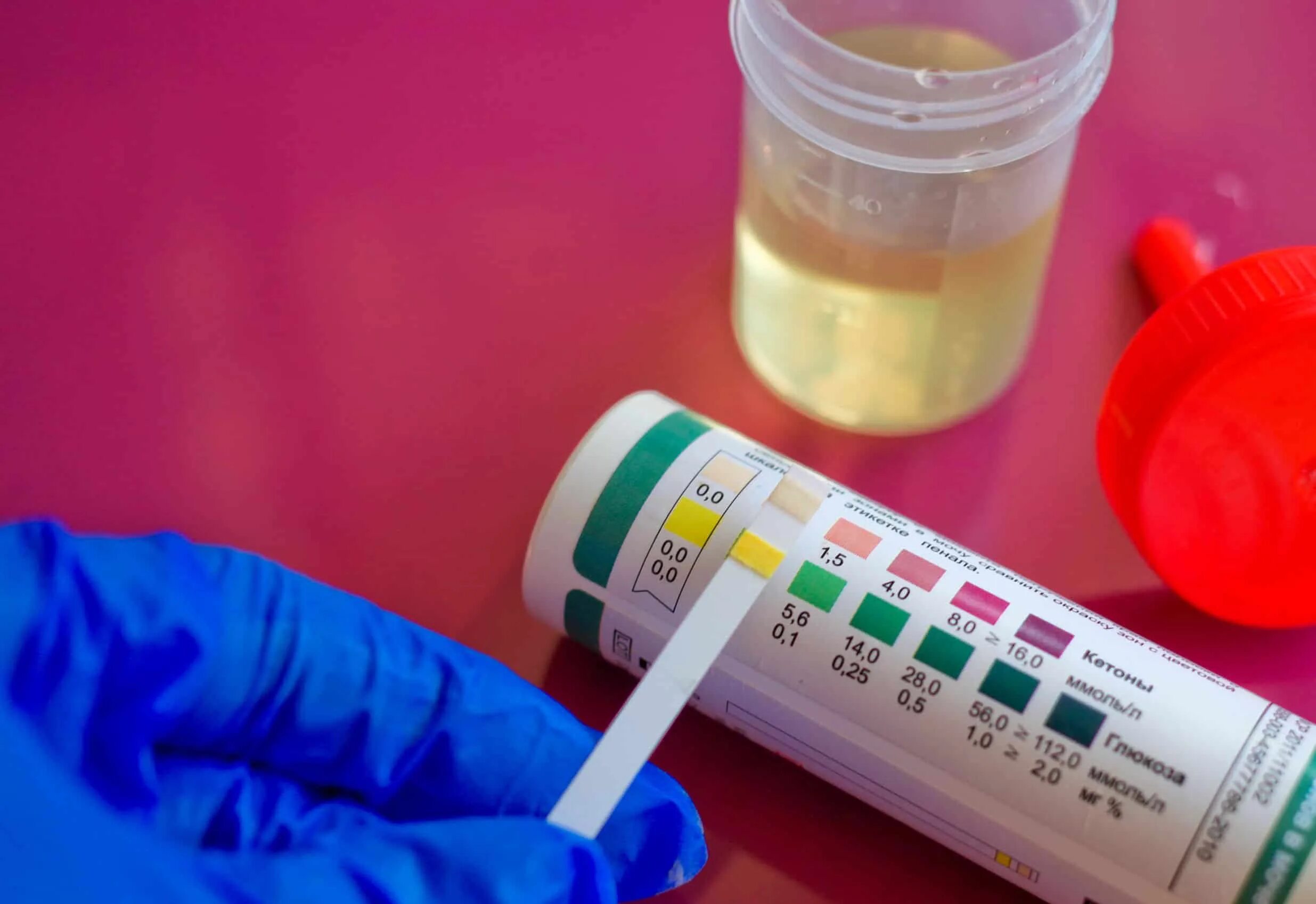 Моча на сахар и ацетон. Анализ мочи на сахар и ацетон. Моча на сахар и ацетон. Исследование суточной мочи на глюкозу. Исследование мочи ацетон в норме.