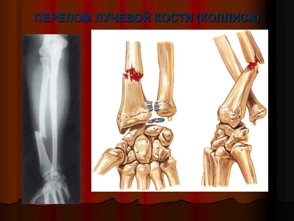 Перелом дистального метаэпифиза Луче-локтевой кости. Перелом лучевой кости (Коллиса):. Перелом лучевой кости Илизаров. Перелом дистального диафиза лучевой кости.