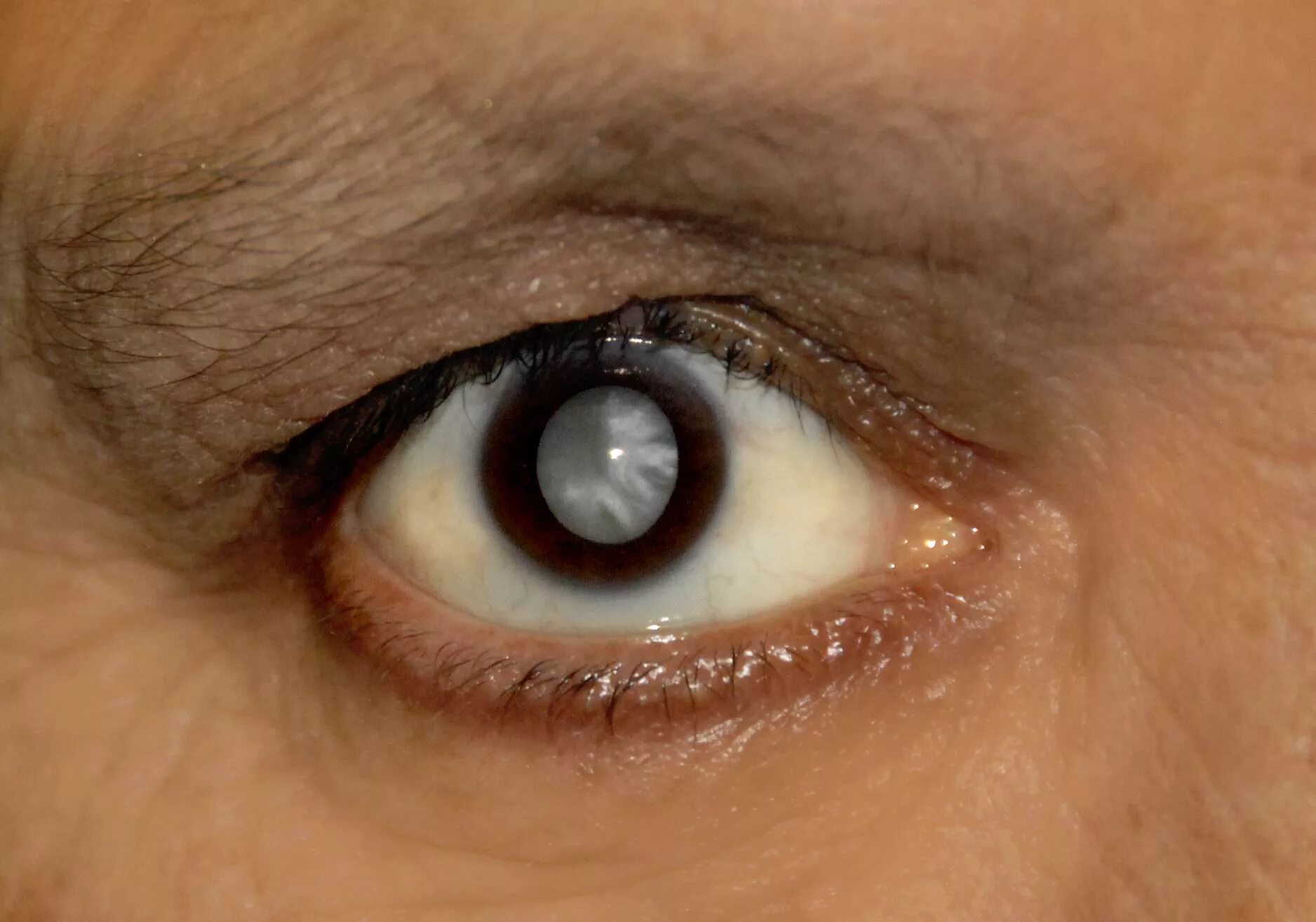 Глазное зрение 1. Пресенильная катаракта.