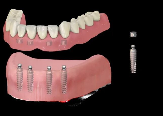 Внутрикорневой аттачмент. Балка на имплантатах аттачмент mk1. Внутрислизистые зубные имплантаты.