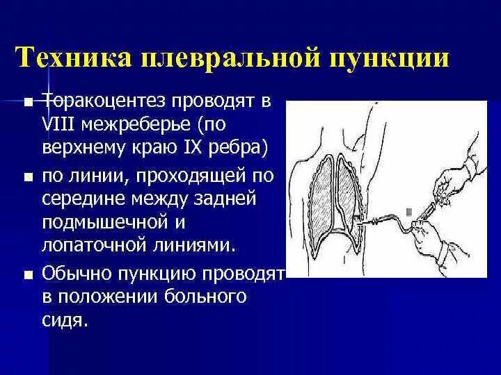 Лечение плевральной полости. Плевральная пункция гидроторакс. Пункция и дренирование плевральной полости. Гидроторакс заболевания. Торакоцентез методика выполнения.