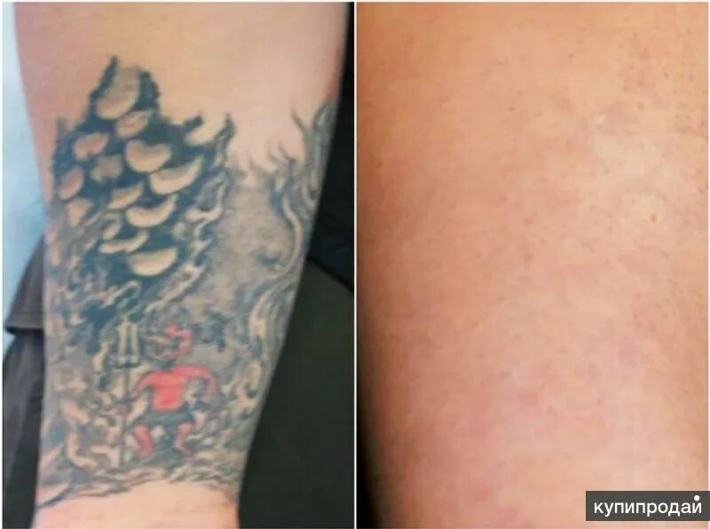 Сведение тату до и после. Удаление татуировок лазером. Сведение тату лазером до и после. Удаление тату цена москва