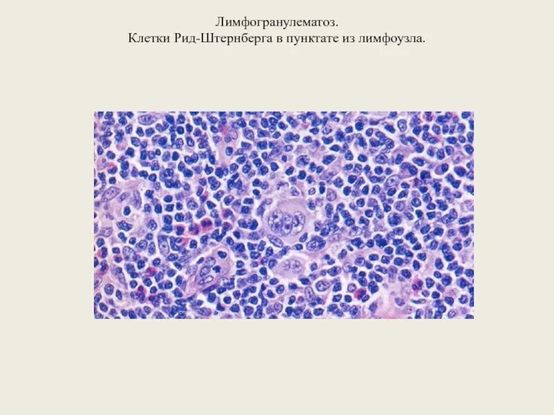 Рид штернберга. Клетки Березовского-Штернберга. Лимфогранулематоз гистология. Лимфома Ходжкина лимфоузел микропрепарат.