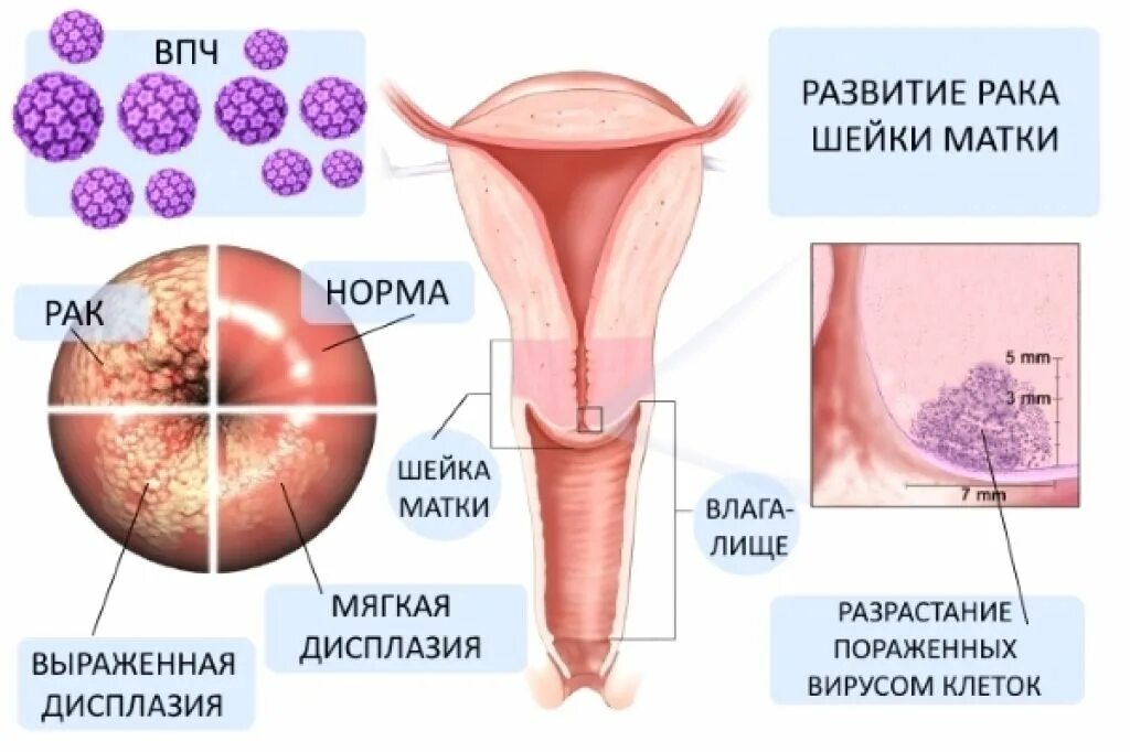 Вирус рака шейки матки. Дисплазия шейки матки HPV. Онкология шейки матки ВПЧ. Дисплазия шейки матки предрак. Папилломавирусная инфекция влагалищные кондиломы.