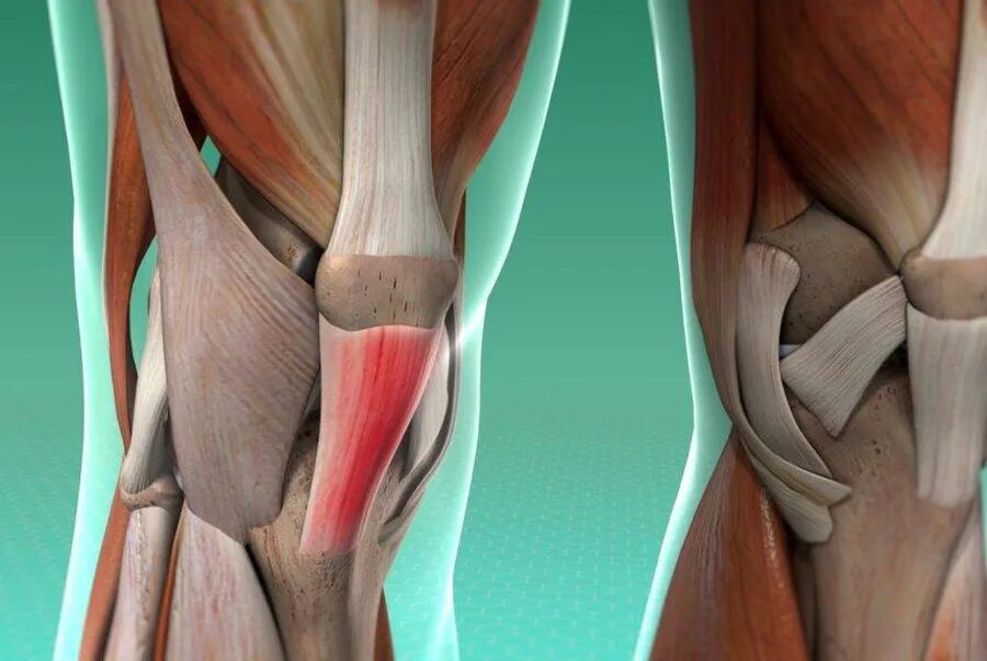 Травма связок сустава. Тинезит коленного сустава. Тендинопатия коленного сустава. Тендинит сухожилия коленного сустава. Тендинит сухожилия подколенной мышцы.