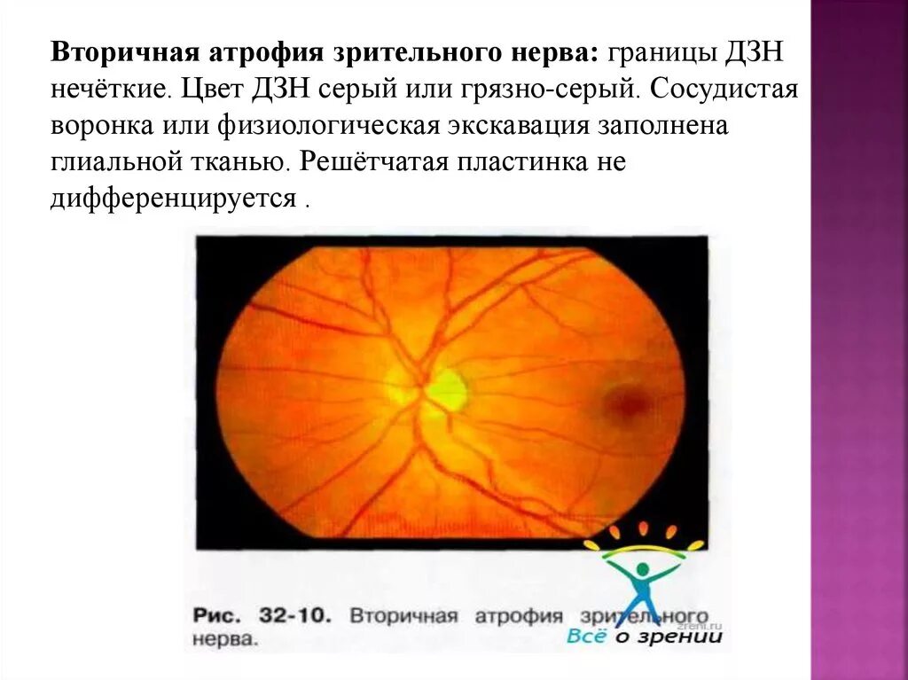 Клинические признаки поражения зрительного нерва. Атрофия зрительного нерва клинические проявления. Постзастойная атрофия диска зрительного нерва. Симптомы патологии зрительного нерва. Тип зрительного нерва