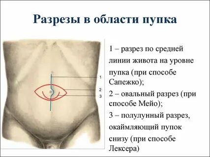 Брюшная стенка после операции