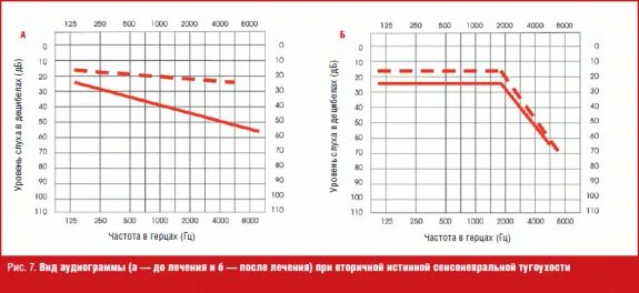 Кондуктивная тугоухость 2 степени аудиограмма. Аудиограмма при сенсоневральной тугоухости. Аудиограмма при профессиональной тугоухости. Нейросенсорная тугоухость 2 степени аудиограмма. Частота 8 герц