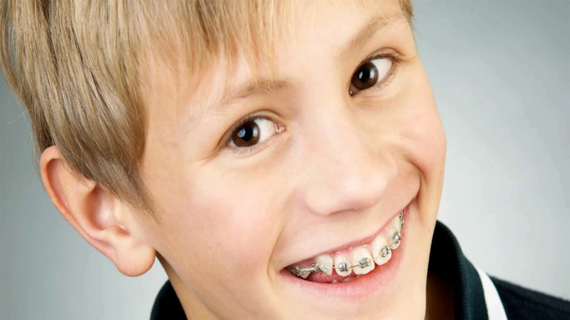 Посеребренные детские зубы. Брекеты для детей 11 лет мальчику. Со скольки лет брекеты можно ставить ребенку