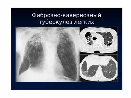Кавернозный туберкулез кт
