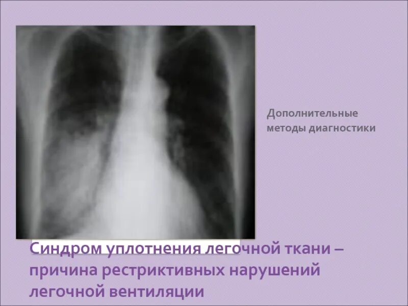 Уплотнение в легких что это. Долевое уплотнение легочной ткани рентген. синдром воспалительного уплотнения легочной ткани рентген. синдром очагового уплотнения легочной ткани рентген. синдром долевого уплотнения легочной ткани рентген.